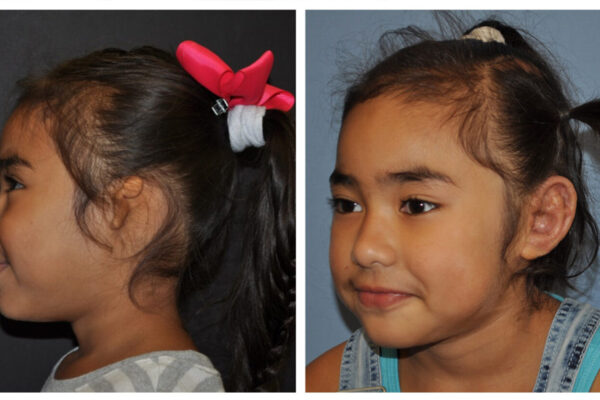 a girl before and after surgery for a new ear