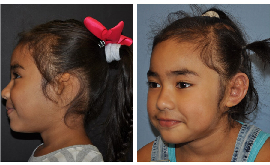 a girl before and after surgery for a new ear